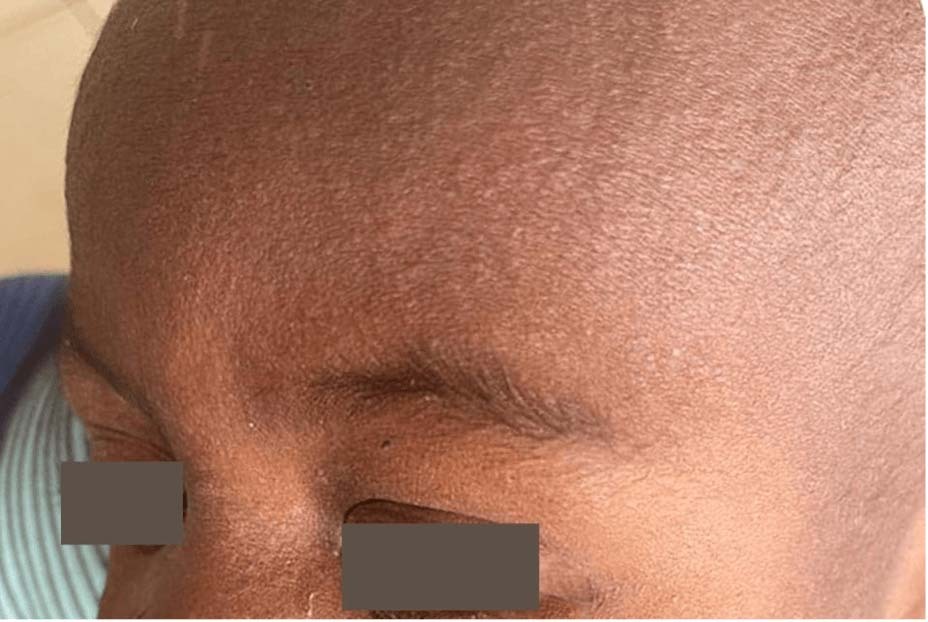 measles-2.jpg