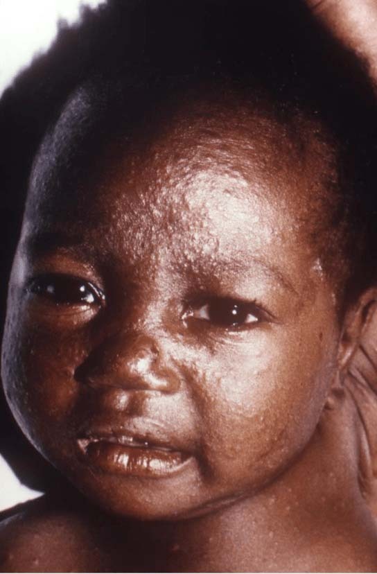 measles-3.jpg