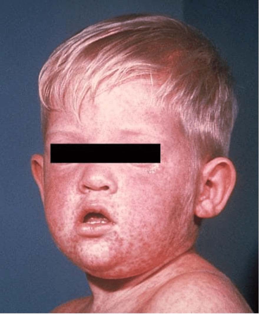 measles-4.jpg